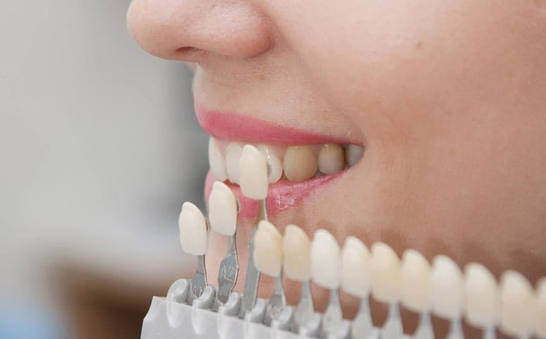 قیمت و هزینه لمینت دندان در تهران