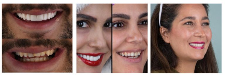 قیمت لمینت دندان