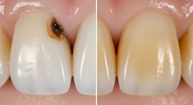 فرق پوسیدگی و تغییر رنگ دندان