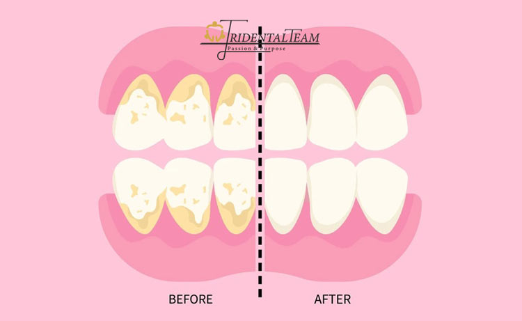جرم گیری به مینای دندان آسیب می زند؟