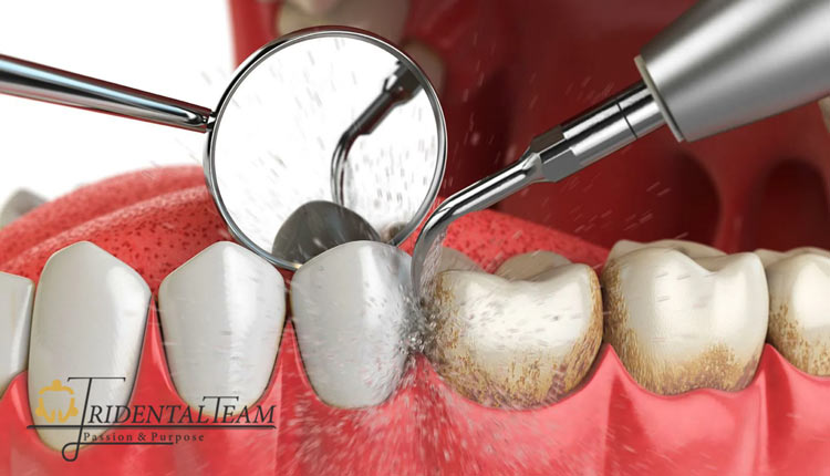 آیا جرم گیری به دندان آسیب می رساند؟