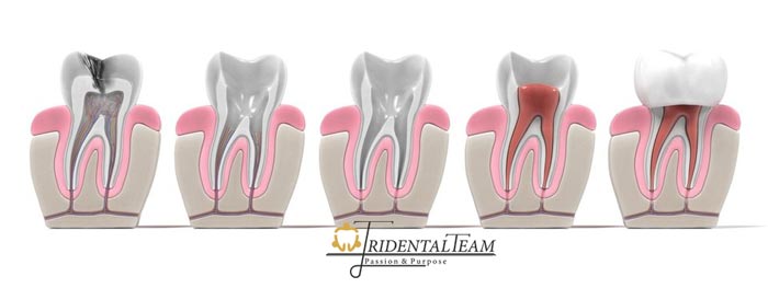 دکتر عصب کشی دندان