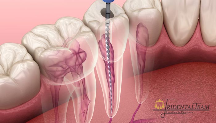 بهترین متخصص عصب کشی دندان