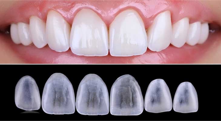 لومینیرز دندان چیست؟