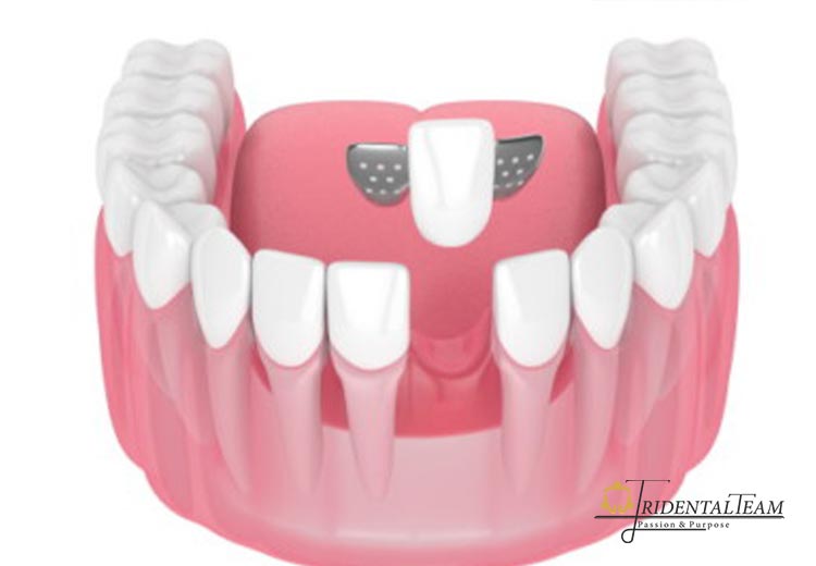 بریج دنباله دار یا مریلند