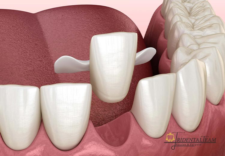بریج مریلند یا دنباله دار