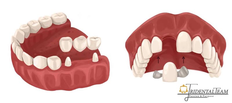 بریج مریلند یا دنباله دار