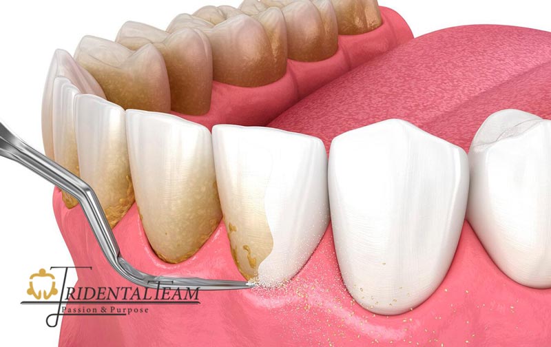 فرق جرم گیری لثه با جرم گیری دندان