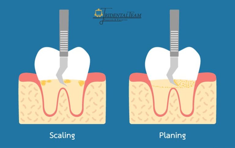 تفاوت جرم گیری لثه و جرم گیری دندان