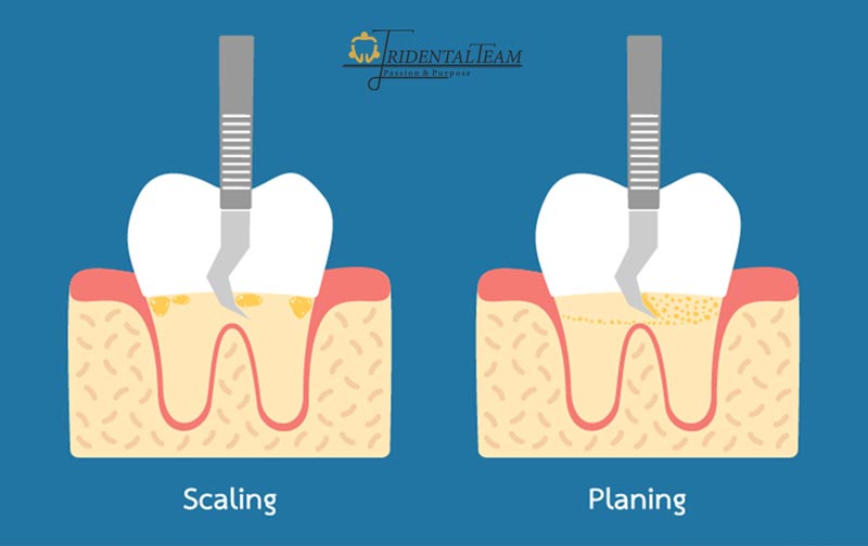 تفاوت جرم گیری لثه و جرم گیری دندان