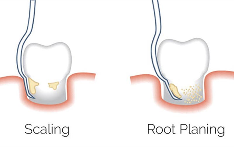 فرق جرم گیری لثه با جرم گیری دندان