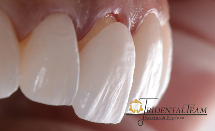 درد کامپوزیت دندان