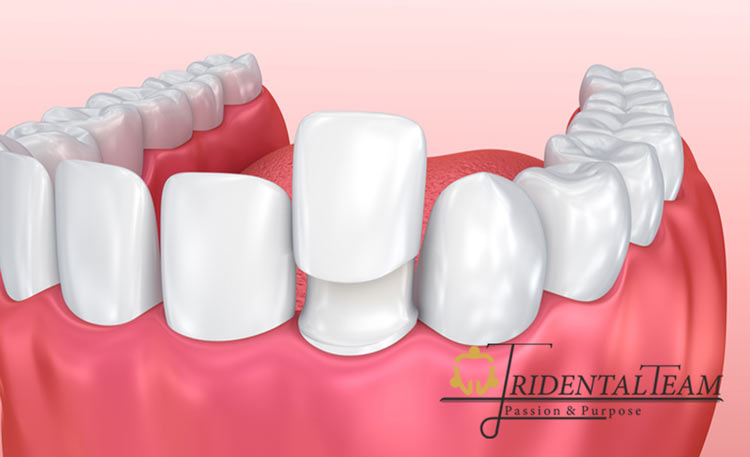 کاهش درد کامپوزیت دندان