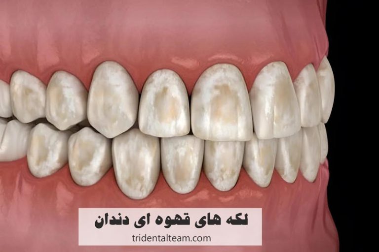 لکه های قهوه ای روی دندان