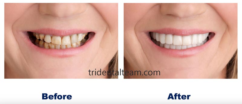 درمان لکه های قهوه ای دندان