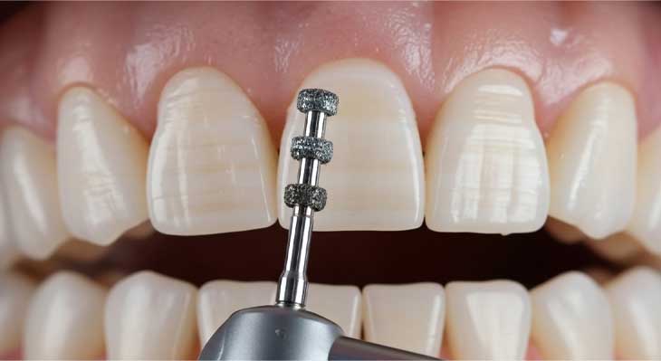 تراش دندان برای لمینت