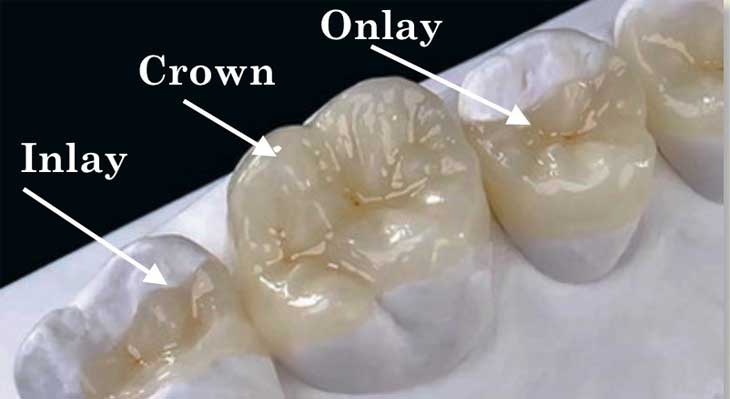 اینله و آنله دندان