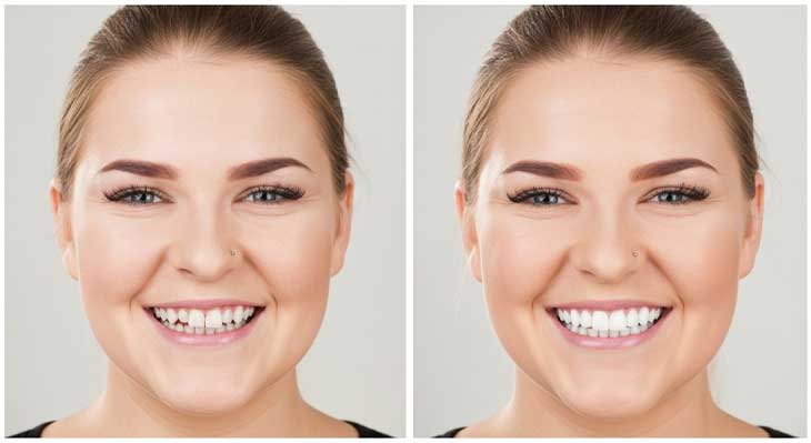 لمینت دندان خرگوشی