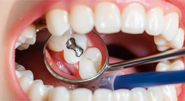 ترمیم دندان کودکان