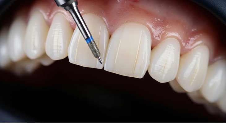 تراش دندان برای لمینت