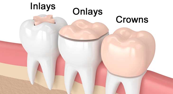 اینله و آنله دندان