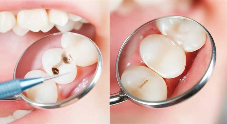 ترمیم دندان کودکان