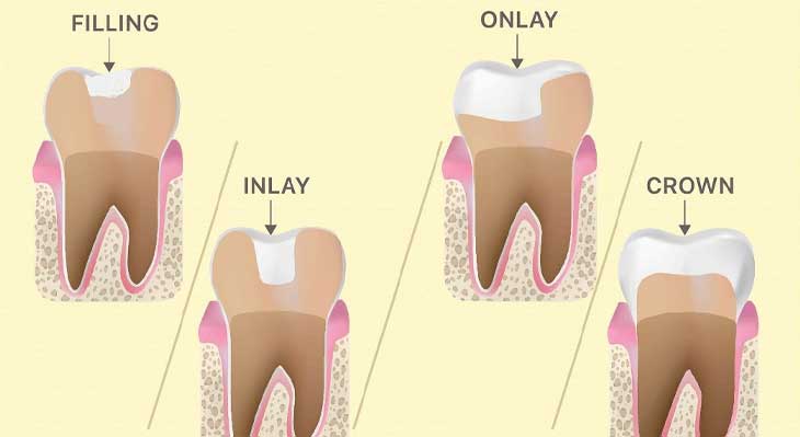 اینله و آنله دندان