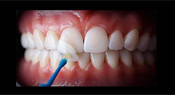 ونیر دندان چیست؟