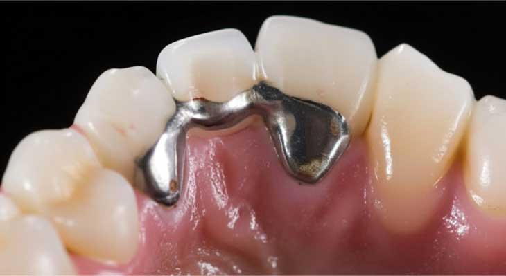 بریج دنباله دار یا مریلند