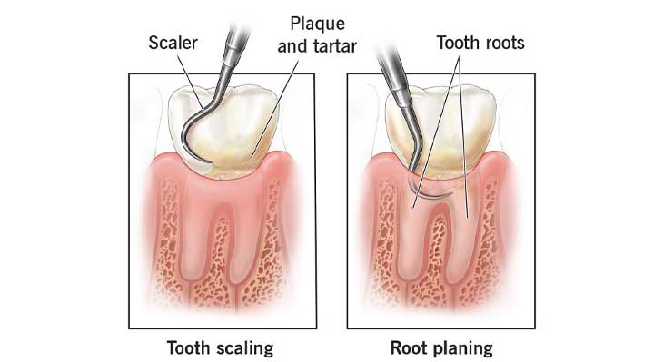 تفاوت جرم گیری سطحی و عمقی دندان