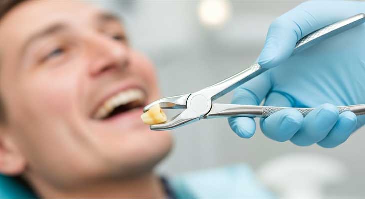 کشیدن دندان