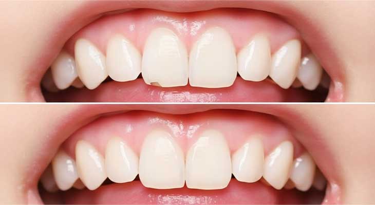 کامپوزیت دندان های جلو
