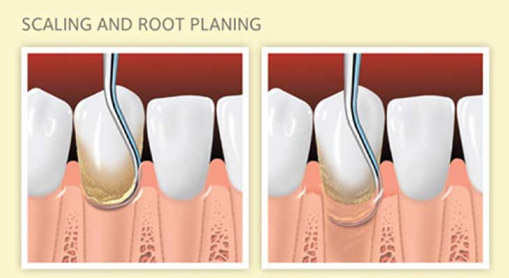تفاوت جرم گیری سطحی و عمقی دندان