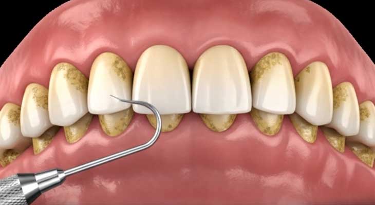 تفاوت بروساژ و جرم گیری دندان