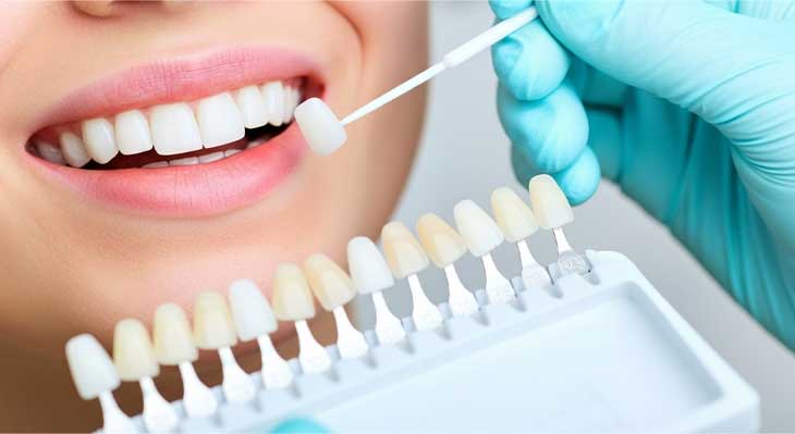 ونیر دندان چیست؟