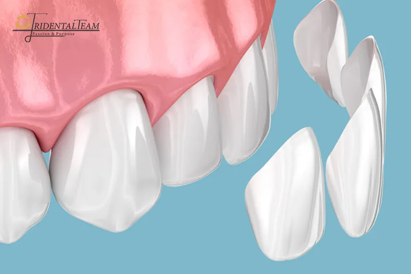 مراقبت در روز اول لمینت دندان