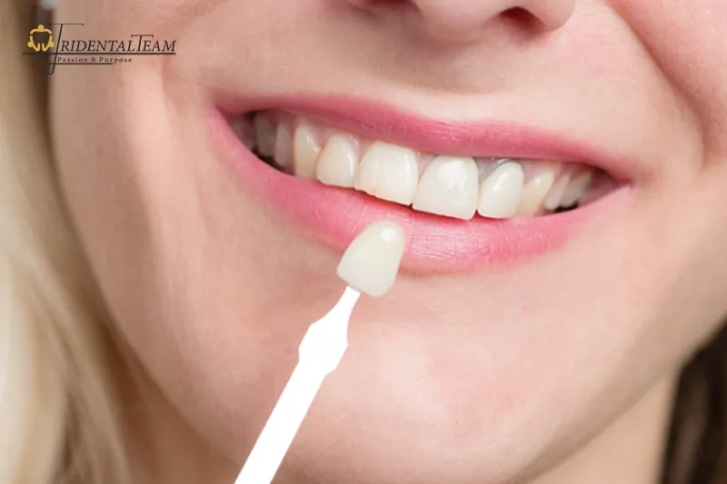 مراقبت در هفته اول لمینت دندان0