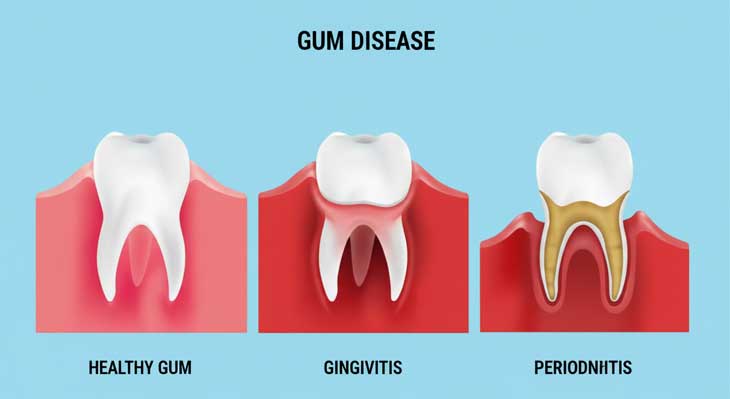 تفاوت ژنژیویت لثه و پریودنتیت لثه
