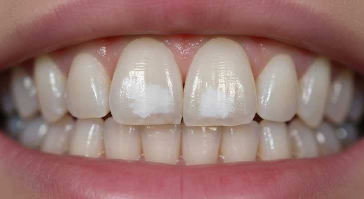 لکه های سفید روی دندان