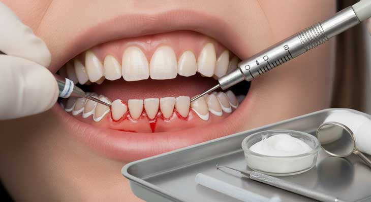 درمان خونریزی لثه