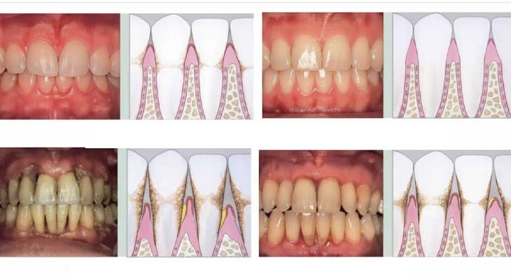 تفاوت ژنژیویت لثه و پریودنتیت لثه