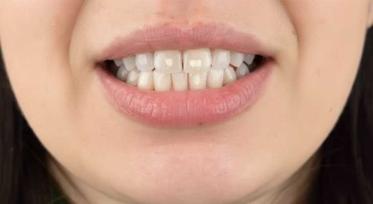 لکه های سفید روی دندان