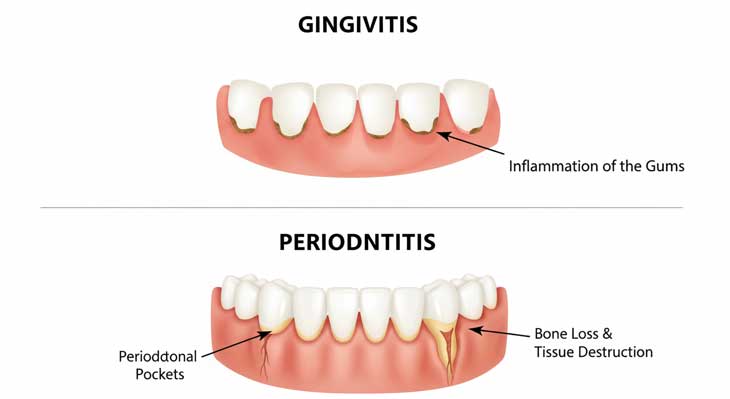 تفاوت ژنژیویت لثه و پریودنتیت لثه
