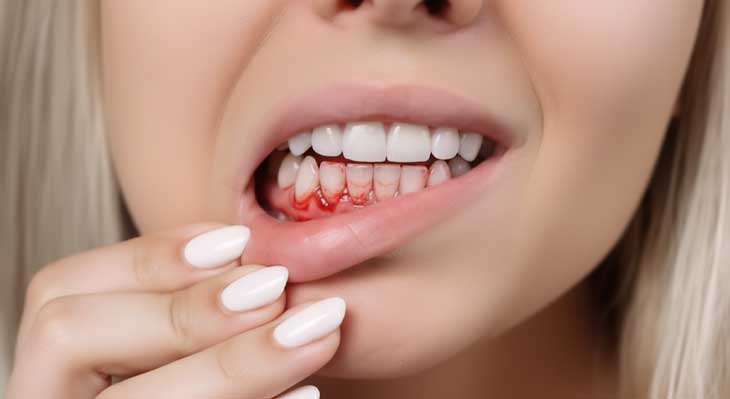 درمان خونریزی لثه