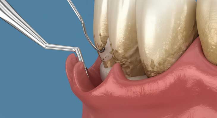 جرم گیری دندان و انواع آن