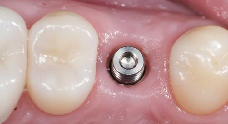 ایمپلنت دندان بدون درد