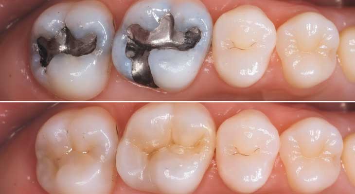 ترمیم دندان