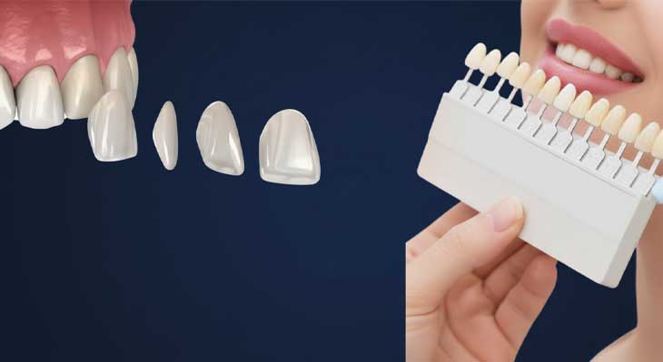 بهترین برند لمینت دندان