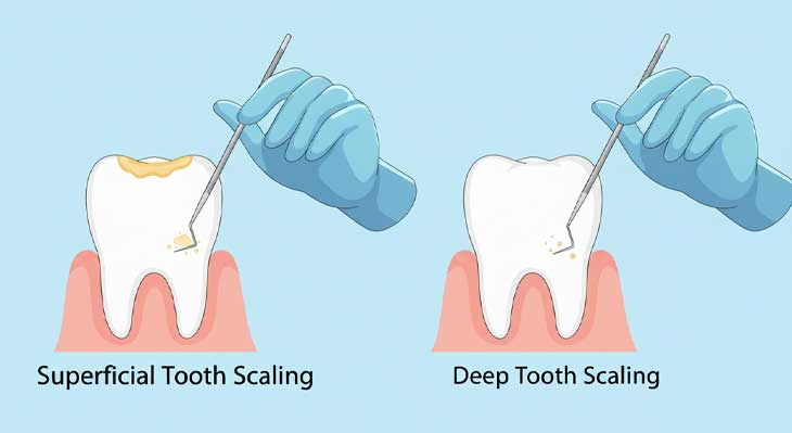 جرم گیری دندان و انواع آن