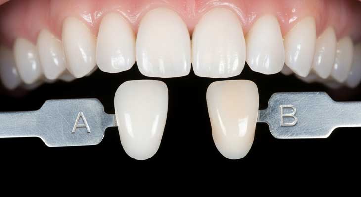 تفاوت رنگ لمینت دندان A و B